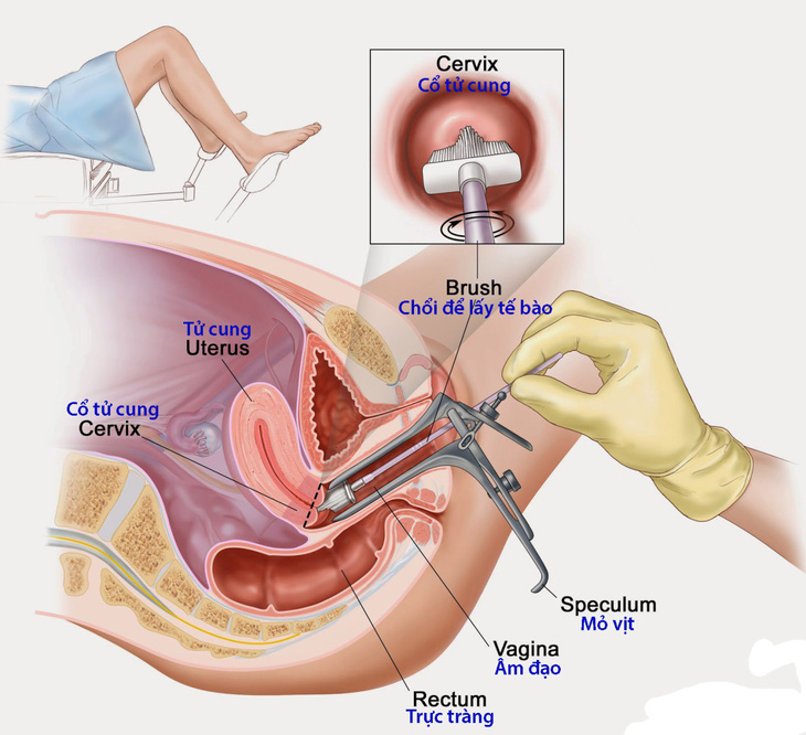 Phát hiện sớm ung thư cổ tử cung - Ảnh 1.