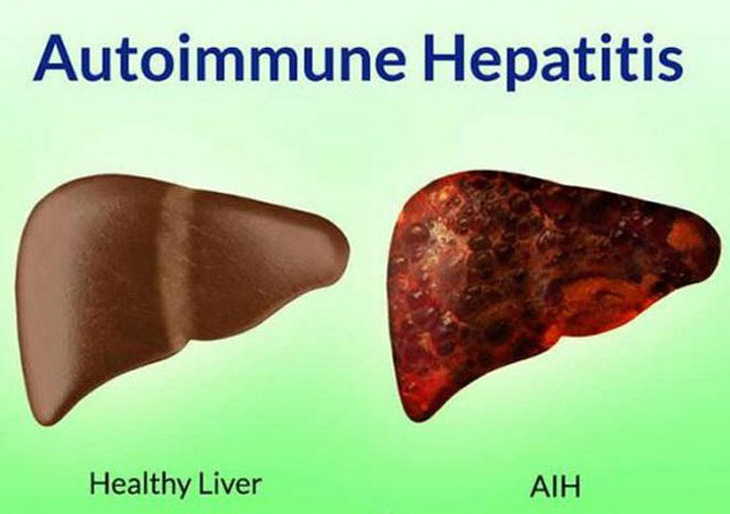 Viêm gan tự miễn trẻ em - Ảnh 1.