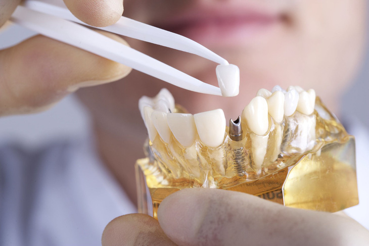 Điều trị thế nào khi trụ răng Implant bị xô lệch? - Ảnh 2.