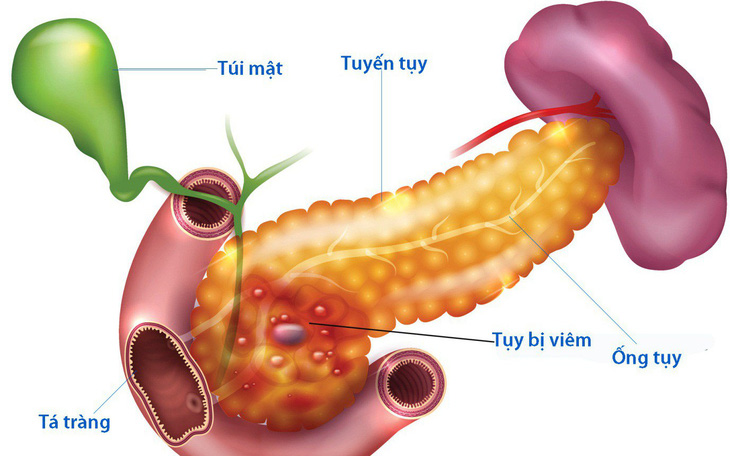 Bệnh viêm tụy cấp