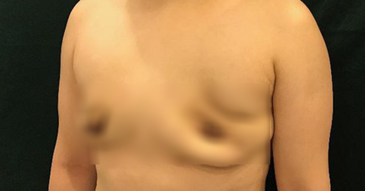 Mất ngực vì tiêm silicon lỏng nâng ngực - Ảnh 1.