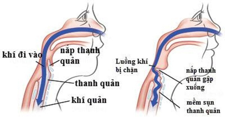 Mềm sụn thanh quản - Ảnh 1.