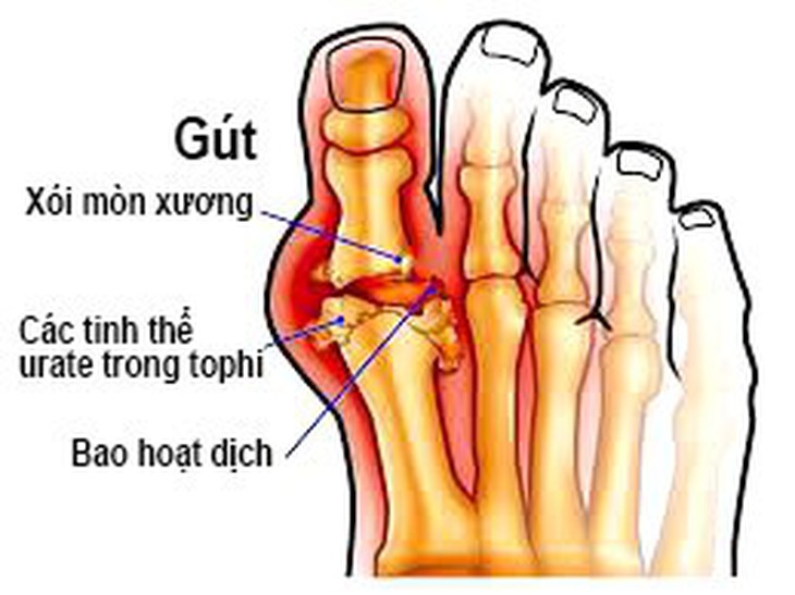 Tránh hiểu sai về căn bệnh khổ sở nhất nhì mùa lễ tết - Ảnh 1. Tránh hiểu sai về căn bệnh khổ sở nhất nhì mùa lễ tết - Ảnh 1.