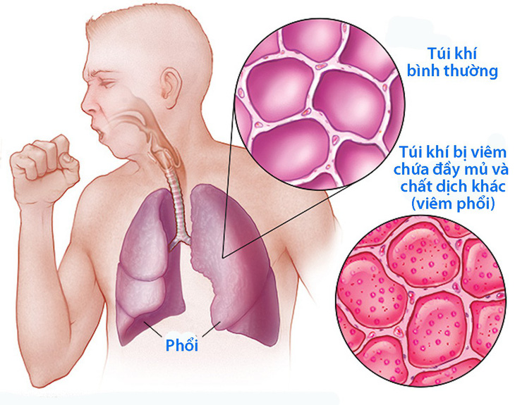 Hiểu đúng về viêm phổi - Ảnh 1.