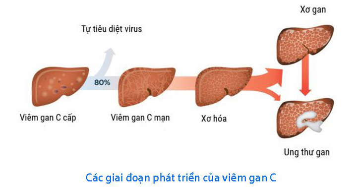 Biểu hiện viêm gan C ở phụ nữ - Ảnh 1.