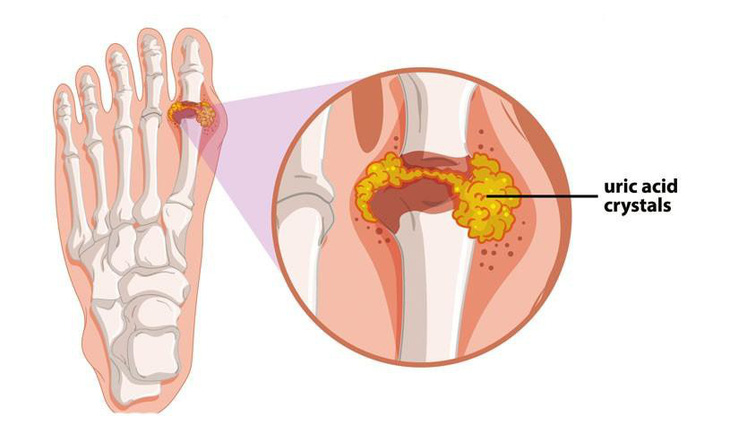 Hạt Cần tây trong Baigout – “vũ khí” chiến thắng bệnh Gout lâu năm - Ảnh 1.