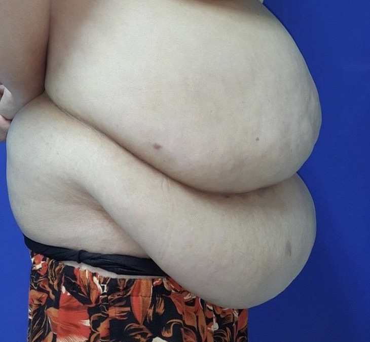 Cắt hơn 6 kg da và mỡ bụng cho nữ bệnh nhân có mỡ xếp thành lớp - Ảnh 1.
