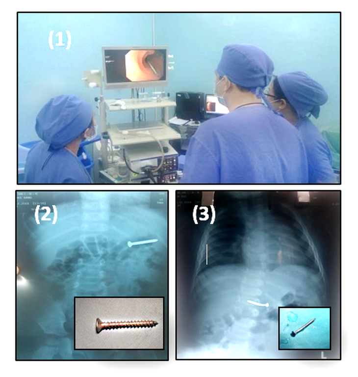 Cấp cứu thành công cùng lúc hai bé trai nuốt đinh nhọn - Ảnh 1.