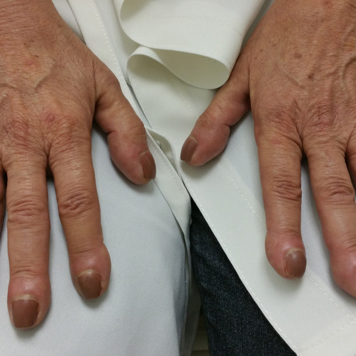 3 dấu hiệu ở ngón tay cảnh báo bạn có thể bị ung thư phổi - Ảnh 2.