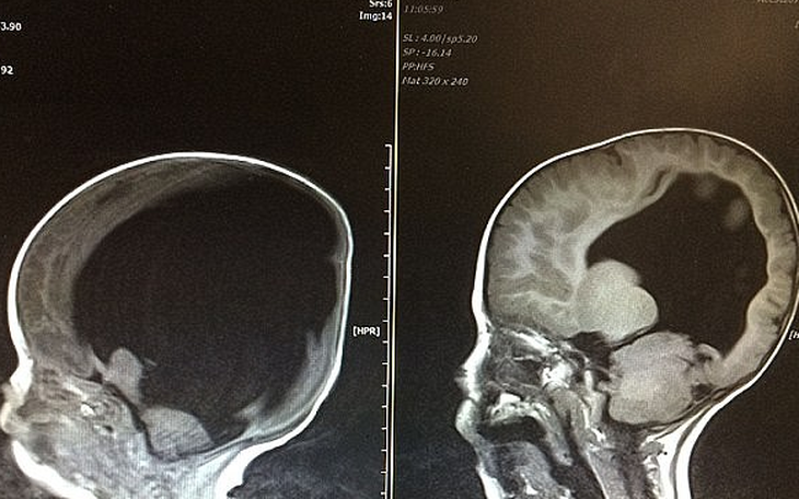 Sức sống kỳ diệu của cậu bé sinh ra ‘không có não’