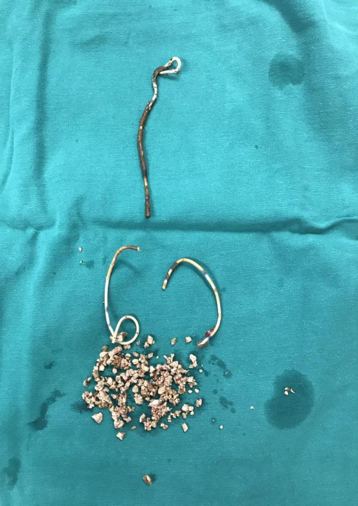 Nữ bệnh nhân quên tái khám rút stent nhựa trong thận và bàng quang - Ảnh 1.