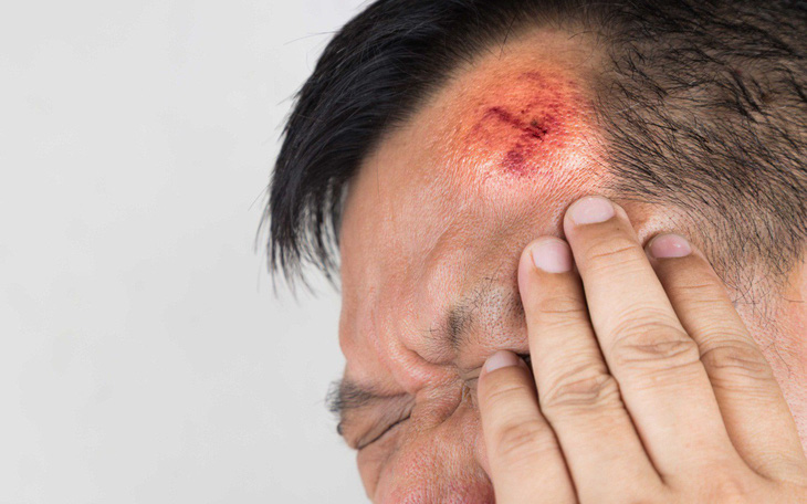 7 dấu hiệu cho thấy bạn cần đi cấp cứu sau một chấn thương đầu