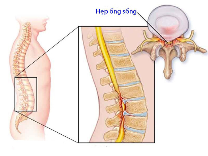 Hẹp ống sống thắt lưng - Ảnh 1.