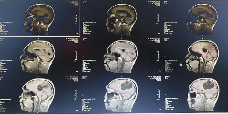 Ổ sán não khổng lồ trong não một nam giới ở Phú Thọ - Ảnh 1.