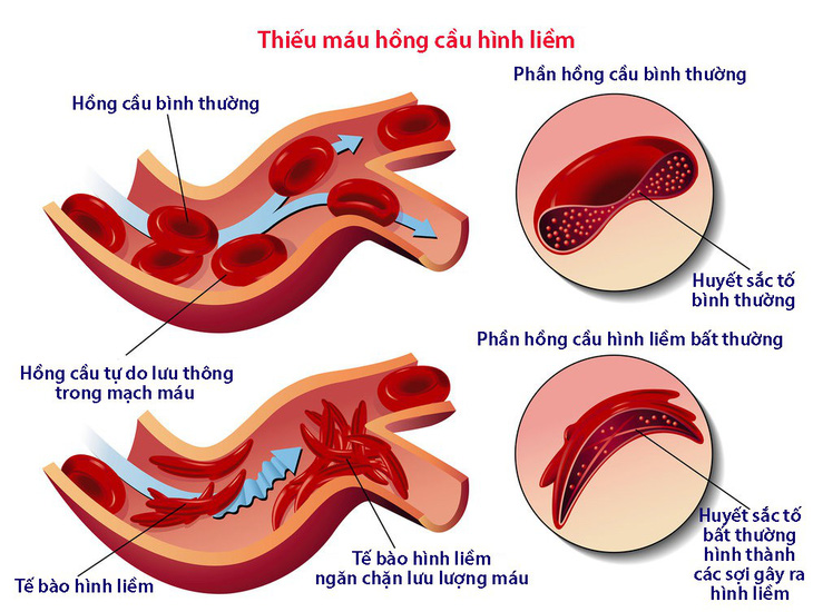 Hội chứng tăng độ nhớt máu - Ảnh 1.