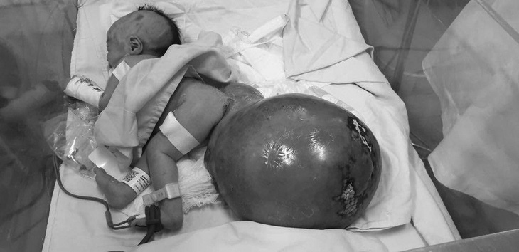Cứu sống bé gái sơ sinh có bướu quái nặng gấp 1,5 lần cơ thể - Ảnh 1.
