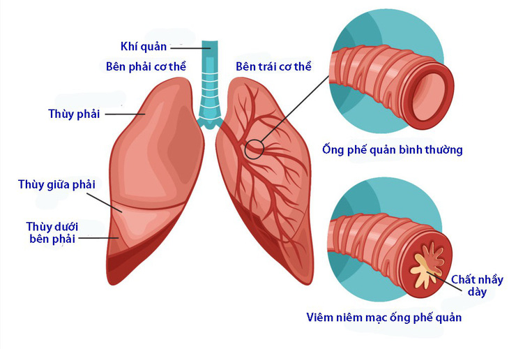 Phân biệt viêm phế quản do virus và viêm phế quản do vi khuẩn - Ảnh 1.