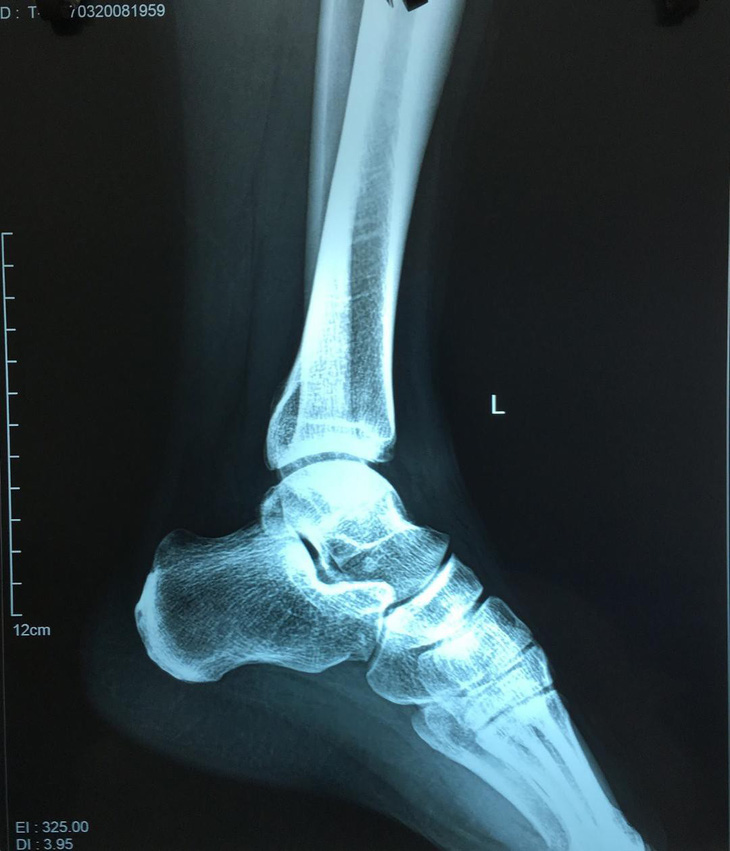 Không gãy xương, trật khớp mà vẫn đau chân vì chấn thương thể thao - Ảnh 1.