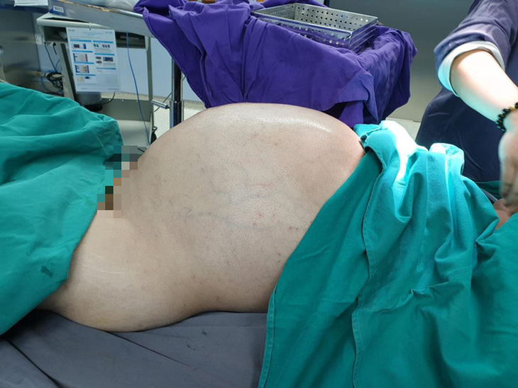 Phẫu thuật lấy khối u 25 kg từ bụng nam thanh niên - Ảnh 1.