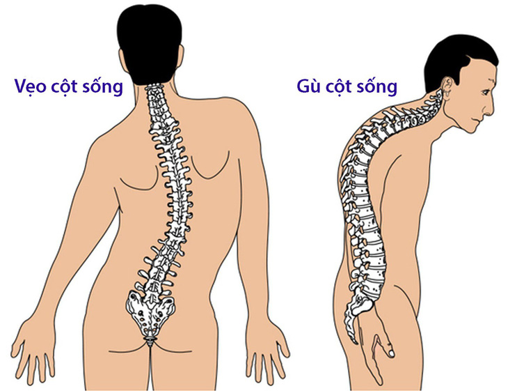 Bệnh lao xương - Ảnh 1.