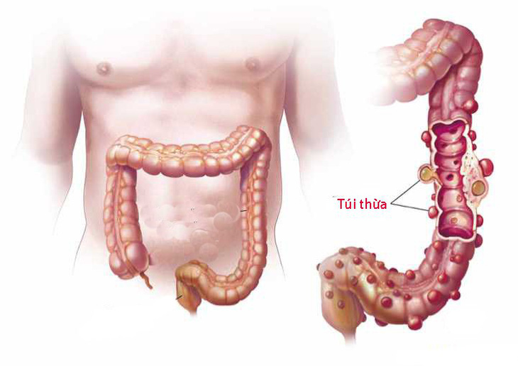 Viêm túi thừa - Ảnh 1.