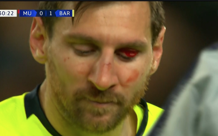 Messi đổ máu trong chiến thắng của Barca trước MU