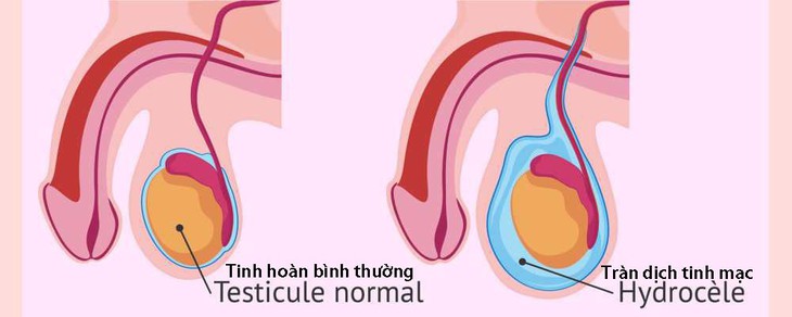 Tràn dịch tinh mạc ở trẻ em - Ảnh 1.