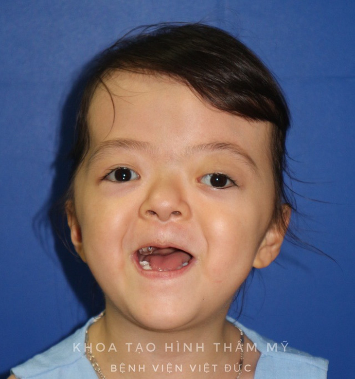 Việt Nam điều trị thành công cho bé hẹp hộp sọ hiếm gặp - Ảnh 2.