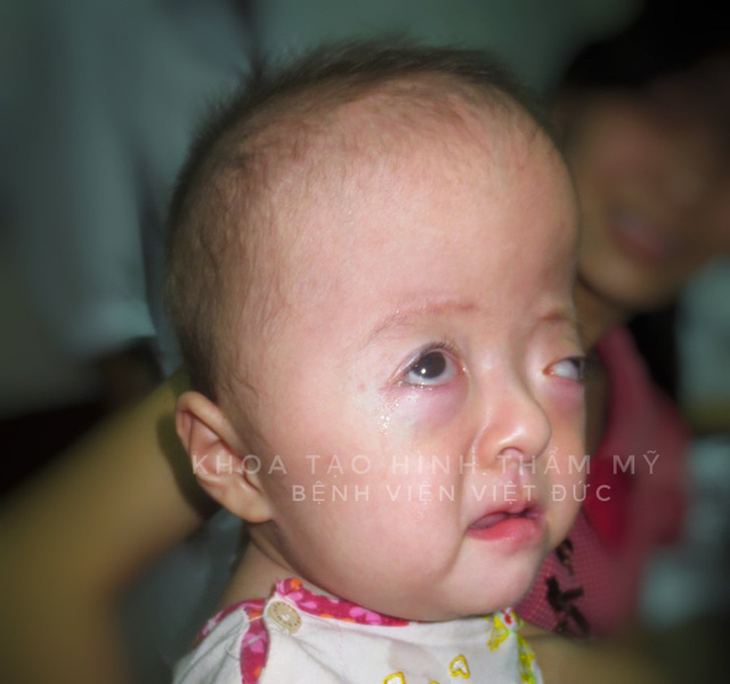 Việt Nam điều trị thành công cho bé hẹp hộp sọ hiếm gặp - Ảnh 1.