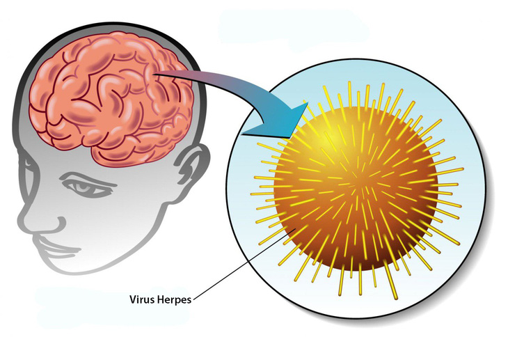 Bệnh viêm não do virus Herpes simplex - Ảnh 1.