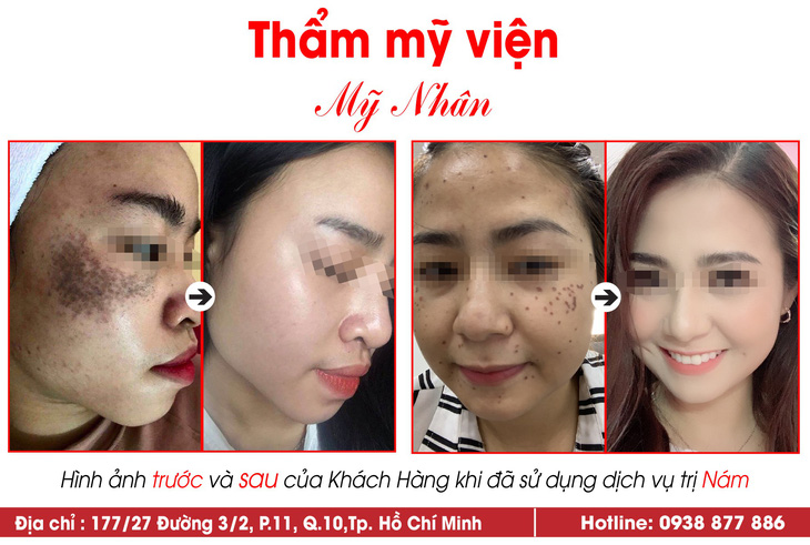 Sạch nám không tái phát nhờ điều trị theo phác đồ y học - Ảnh 1.