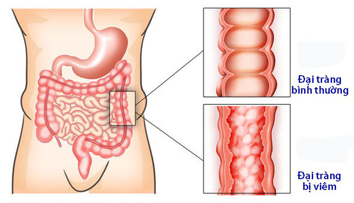 Viêm đại tràng co thắt mạn tính - Ảnh 1.