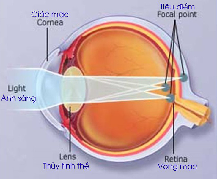 Loạn thị, nguyên nhân và cách điều trị - Ảnh 1.