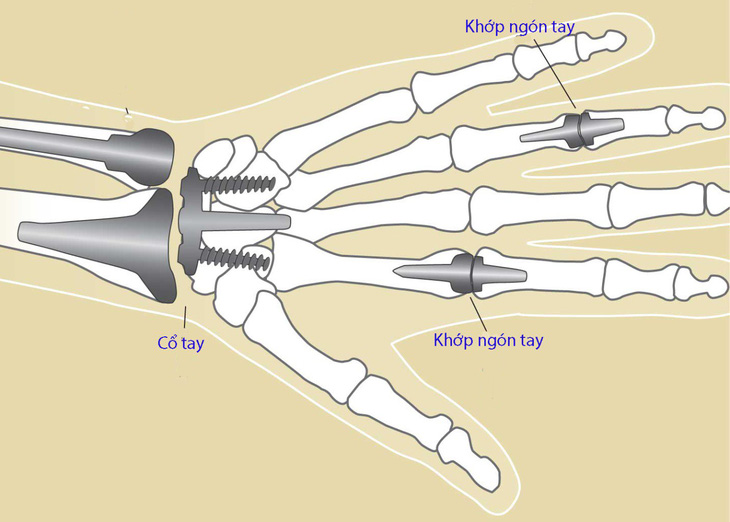 Viêm khớp ngón tay - Ảnh 1.