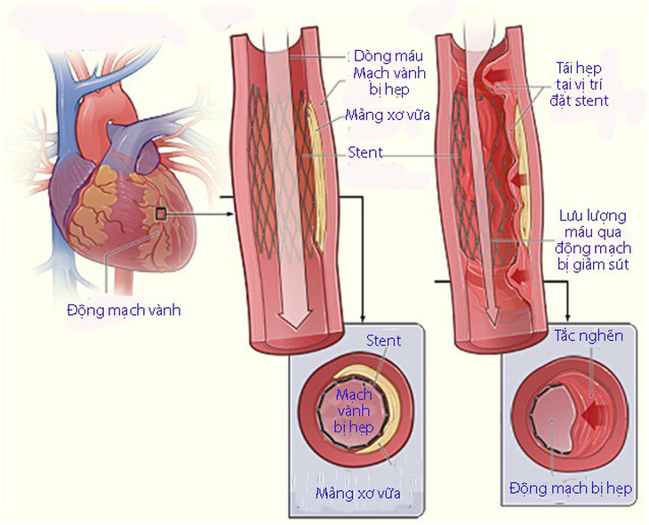 Tái hẹp sau nong mạch và đặt stent - Ảnh 1.