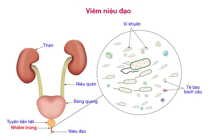 Viêm niệu đạo - Ảnh 1.