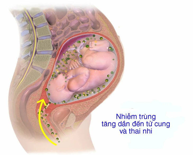 Viêm màng ối và thai kỳ - Ảnh 1.