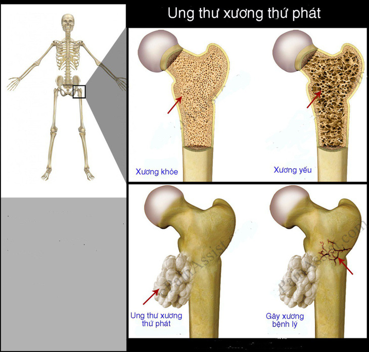 Ung thư di căn xương - Ảnh 1.