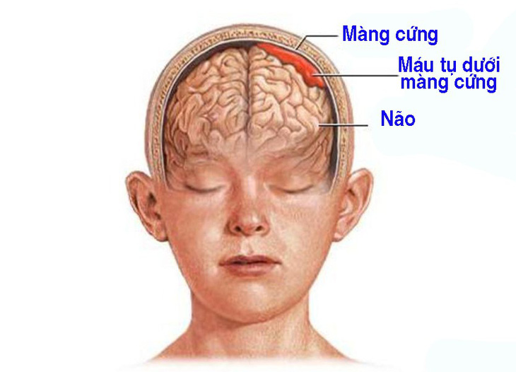 Máu tụ dưới màng cứng - Ảnh 1.