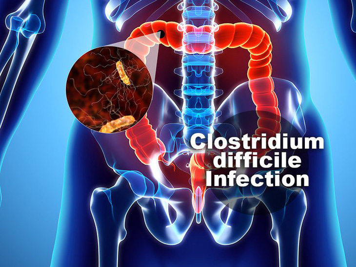 Nhiễm Clostridium Difficile - Ảnh 1.