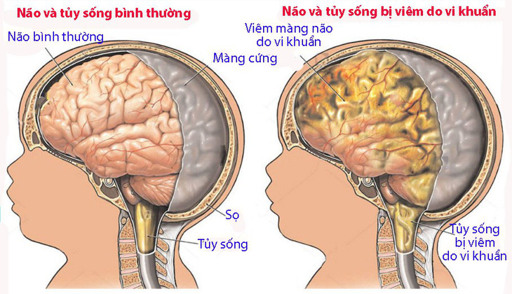 Viêm màng não sơ sinh - Ảnh 1.