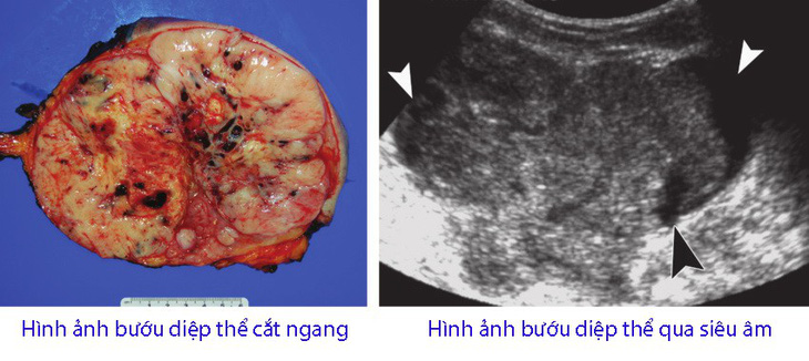 Bướu diệp thể ở vú. - Ảnh 1.