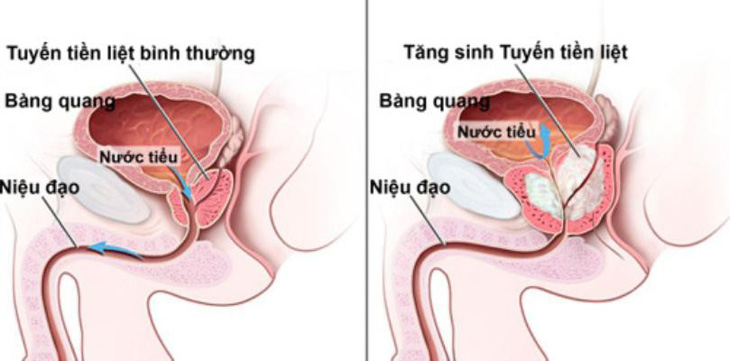 Đi tìm lời giải cho những băn khoăn khi chọn mua sản phẩm điều trị phì đại tuyến tiền liệt - Ảnh 1.