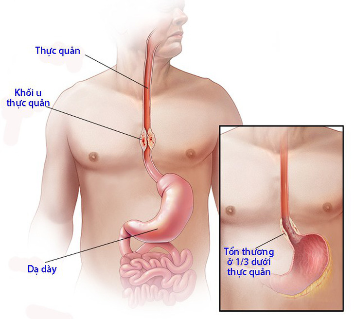Bệnh thực quản Barrett - Ảnh 1.