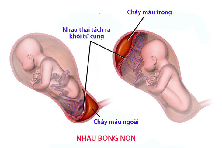 Tình trạng chảy máu khi mang thai - Ảnh 1.