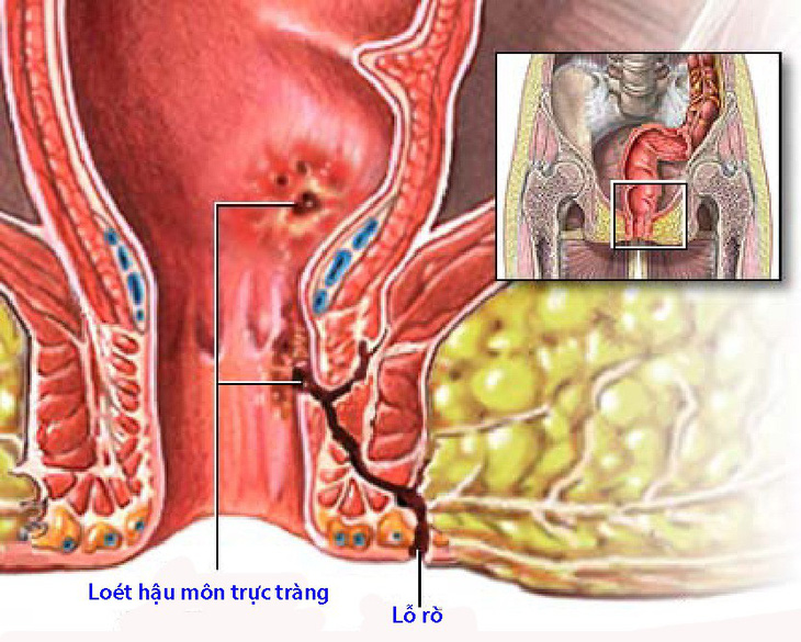 Bệnh Crohn quanh hậu môn - Ảnh 1.