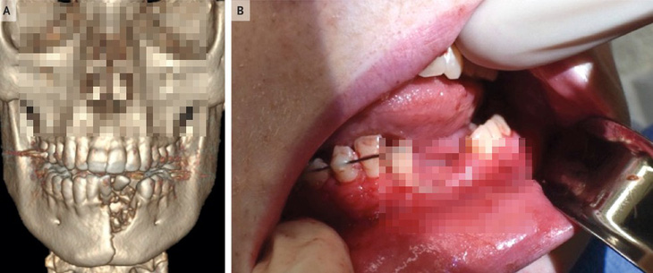 Vỡ hàm, mất răng vì thuốc lá điện tử nổ - Ảnh 1.