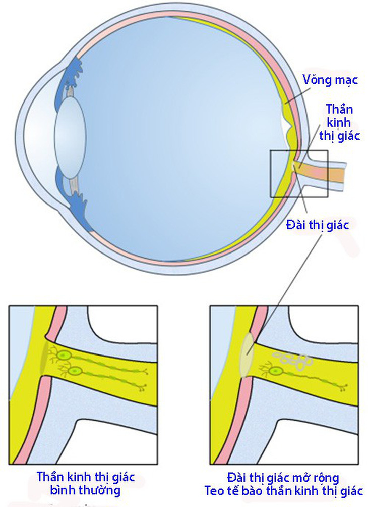 Teo dây thần kinh thị giác: Bệnh thường gặp ở người lớn tuổi - Ảnh 1.