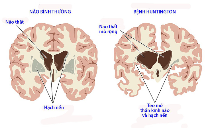 Bệnh Huntington - Ảnh 1.