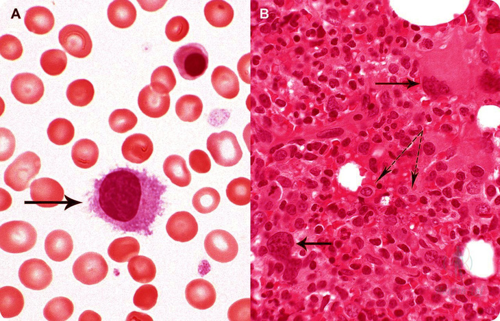 Bệnh đa hồng cầu nguyên phát - Ảnh 1.